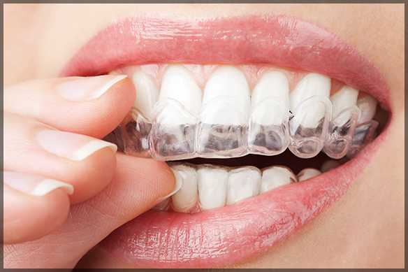 Dental Veneers Dental Veneers