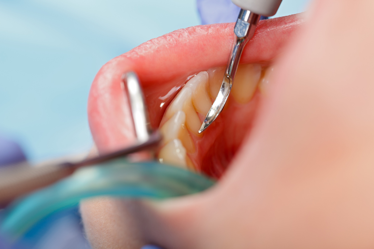 Understanding Gum Disease
